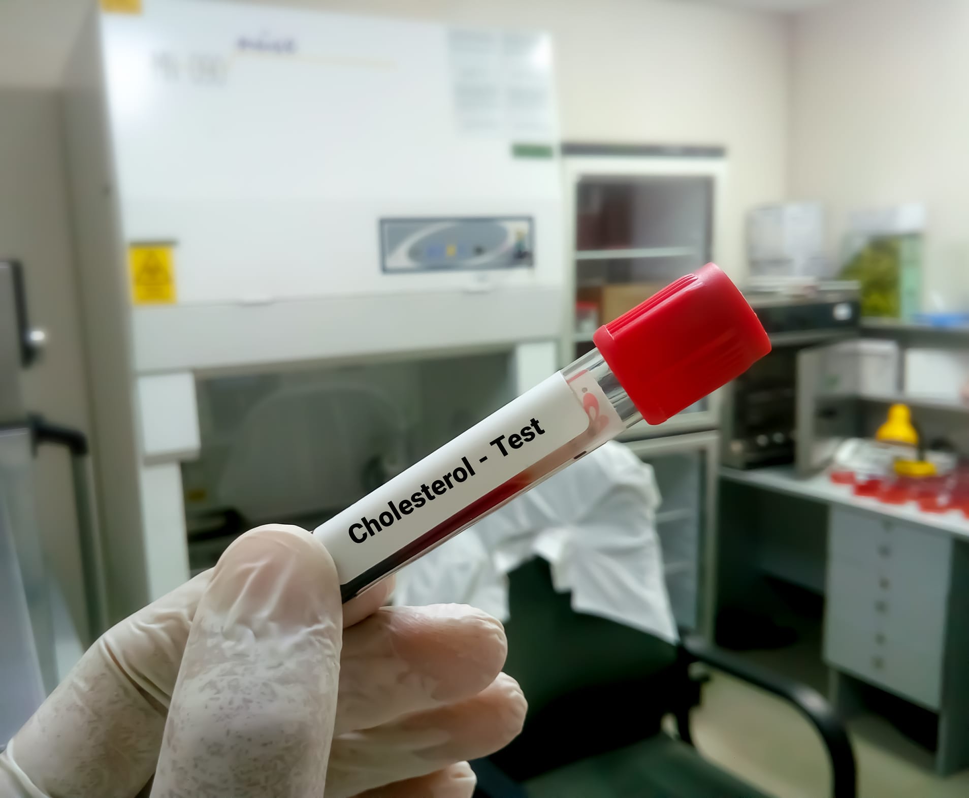 Blood sample for cholesterol testing,